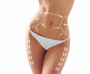 Cryolipolysis 300x247 1